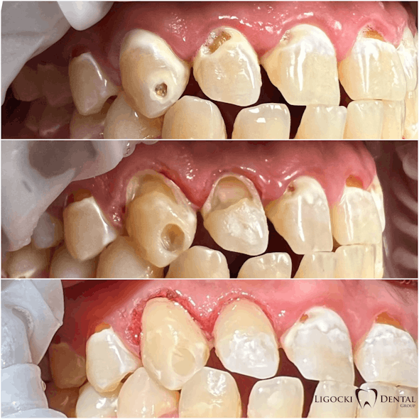 Figure 2: Nos. 6 and 7 are facial carious lesions. Caries were removed with the Solea laser at 40% power, 9 mL mist, medium air, and 1.25 mm spot size. The gingivectomy was performed by reducing the power to 20%, resulting in zero to minimal bleeding. The teeth were restored with Ivoclar Adhese and Tetric Prime Flow. Photos were taken before, during, and immediately after completion.