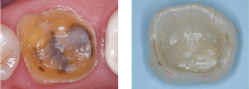 Figure 2: Old cements such as zinc phosphate used with gold alloy crowns almost never came off in service. Why are zirconia crowns coming off frequently&mdash;e.g., flexible cement and smooth internals, etc.?
