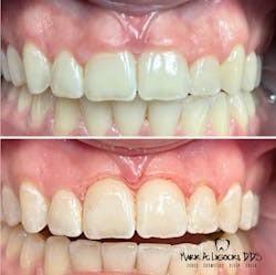Figure 3: Gingivectomy performed with Solea laser before and immediately after Figure 3: Gingivectomy performed with Solea laser before and immediately after