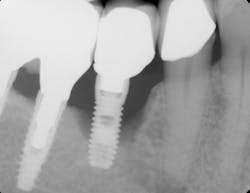 Figure 3: Why are implants failing frequently? What can be done to prevent peri-implantitis and bone loss?
