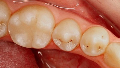 An ingeniously simple caries detector Dental Economics