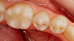 Figure 1: Pit and fissure staining prevalent on nos. 20 and 21. Figure 1: Pit and fissure staining prevalent on nos. 20 and 21.