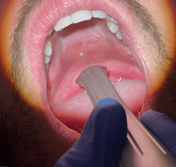 Intraoral view of Solea Sleep procedure being performed Intraoral view of Solea Sleep procedure being performed