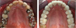 Figures 1 and 2: This patient had received no information from his previous dentists that the restorations in his mouth would eventually have to be replaced. He was concerned when he was told that to restore him to his desired esthetic and functional condition would be an extensive rehabilitation. He was pleased with the restorative result. Only one tooth was not crowned.