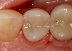 After: The amalgam and secondary caries were removed and replaced with G-aenial A'CHORD After: The amalgam and secondary caries were removed and replaced with G-aenial A'CHORD
