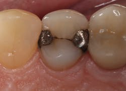 Before: Tooth #12 with failing amalgam restorative margins Before: Tooth #12 with failing amalgam restorative margins