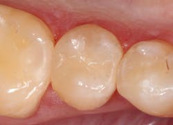 After: The existing composite was removed and the tooth was restored with G-aenial A'CHORD After: The existing composite was removed and the tooth was restored with G-aenial A'CHORD