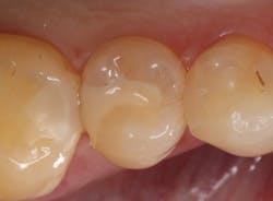 Before: Secondary caries were diagnosed radiographically Before: Secondary caries were diagnosed radiographically
