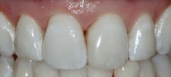 Anterior after: A post-op image after the composite was replaced Anterior after: A post-op image after the composite was replaced