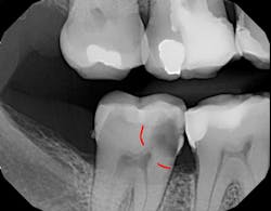 Figure 1: Bitewing radiograph showing deep radiolucency on the mesial approaching the pulp. Figure 1: Bitewing radiograph showing deep radiolucency on the mesial approaching the pulp.