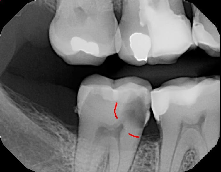 Figure 1: Bitewing radiograph showing deep radiolucency on the mesial approaching the pulp.
