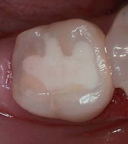 Figure 3: Final occlusal restoration immediately after placement. In hindsight, shade A2 initially appeared a little too light. Figure 3: Final occlusal restoration immediately after placement. In hindsight, shade A2 initially appeared a little too light.