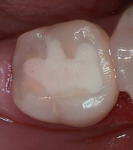 Figure 3: Final occlusal restoration immediately after placement. In hindsight, shade A2 initially appeared a little too light.