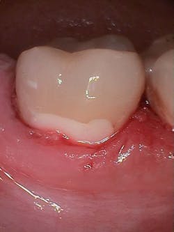 Figure 4: Final buccal restoration immediately after placement. In hindsight, shade A2 initially appeared a little too light. Figure 4: Final buccal restoration immediately after placement. In hindsight, shade A2 initially appeared a little too light.