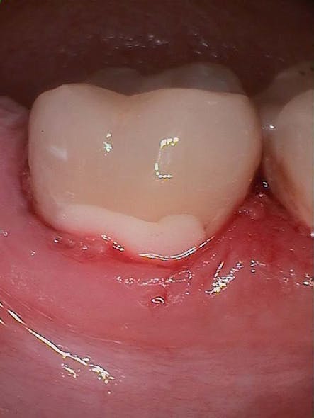 Figure 4: Final buccal restoration immediately after placement. In hindsight, shade A2 initially appeared a little too light.