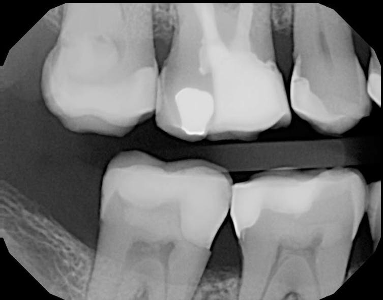 Figure 5: 36-month bitewing follow-up demonstrating remineralization at the mesial buccal pulp horn