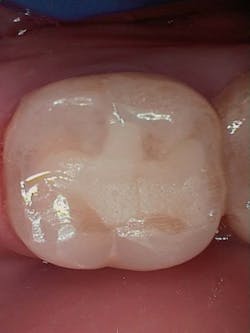 Figure 6: 18-month follow-up photo of occlusal restoration showing shade improvement. Clinical tip: never dry GIC (including when taking a photo). Figure 6: 18-month follow-up photo of occlusal restoration showing shade improvement. Clinical tip: never dry GIC (including when taking a photo).