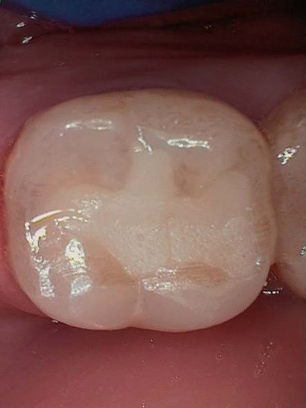 Figure 6: 18-month follow-up photo of occlusal restoration showing shade improvement. Clinical tip: never dry GIC (including when taking a photo).