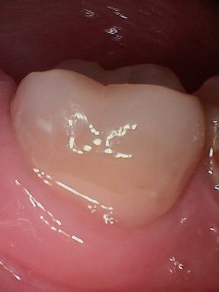 Figure 7: 18-month follow-up photo of buccal restoration showing shade improvement