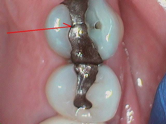 Figure 8: Initial presentation of a fractured amalgam restoration