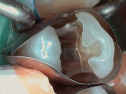 Figure 9: Amalgam removed, showing an asymptomatic fracture and undermined enamel Figure 9: Amalgam removed, showing an asymptomatic fracture and undermined enamel