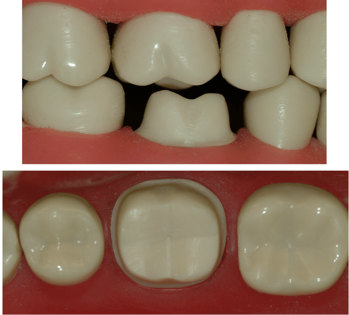 Successful cementing of zirconia crowns Still a problem Dental Economics