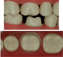 Figure 2: Full-strength zirconia can be strong at 0.6 mm of thickness, but reduced-strength zirconia needs deeper preps.