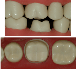 Figure 2: Full-strength zirconia can be strong at 0.6 mm of thickness, but reduced-strength zirconia needs deeper preps. Figure 2: Full-strength zirconia can be strong at 0.6 mm of thickness, but reduced-strength zirconia needs deeper preps.