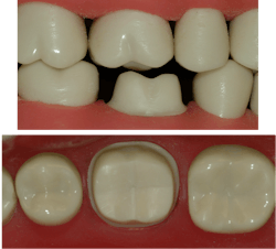 Figure 2: Full-strength zirconia can be strong at 0.6 mm of thickness, but reduced-strength zirconia needs deeper preps. Figure 2: Full-strength zirconia can be strong at 0.6 mm of thickness, but reduced-strength zirconia needs deeper preps.