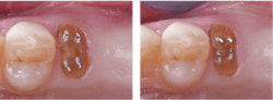 Figure 3: Retentive pure titanium pins produce significant retention for buildup materials. Note that the pins are placed at least 15 degrees from the long axis of the tooth and bent over easily to be retentive for the composite and not come out as the dentin relaxes. Figure 3: Retentive pure titanium pins produce significant retention for buildup materials. Note that the pins are placed at least 15 degrees from the long axis of the tooth and bent over easily to be retentive for the composite and not come out as the dentin relaxes.