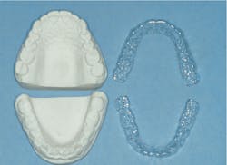 Figure 4: Fluoride (5,000 ppm) in trays is recommended for patients with high-caries activity. Figure 4: Fluoride (5,000 ppm) in trays is recommended for patients with high-caries activity.