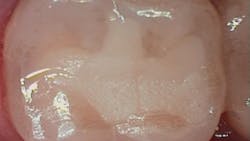 Fig 6 36 Mo Po Occlusal 63b46a8151d07 Fig 6 36 Mo Po Occlusal 63b46a8151d07