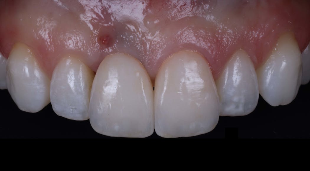 Figure 6: Intraoral photograph illustrating real-world clinical detours: (a) Unresolved peri-implant infection as a result of excess cement left over from the restoration placed by the previous provider, (b) Both central incisor restorations possess inappropriate chroma compared with the adjacent dentition due to patient non-compliance with clinical recommendations to cease tooth bleaching two weeks prior to final shade analysis.