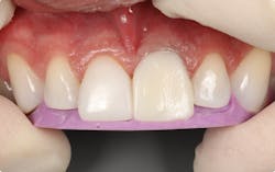 Figure 5: Repeat steps on the contralateral central incisor. Note that tooth no. 8 was adjusted for primary anatomy and contours. Figure 5: Repeat steps on the contralateral central incisor. Note that tooth no. 8 was adjusted for primary anatomy and contours.