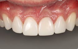 Figure 7: Try in all veneers and confirm shade, contours. Figure 7: Try in all veneers and confirm shade, contours.