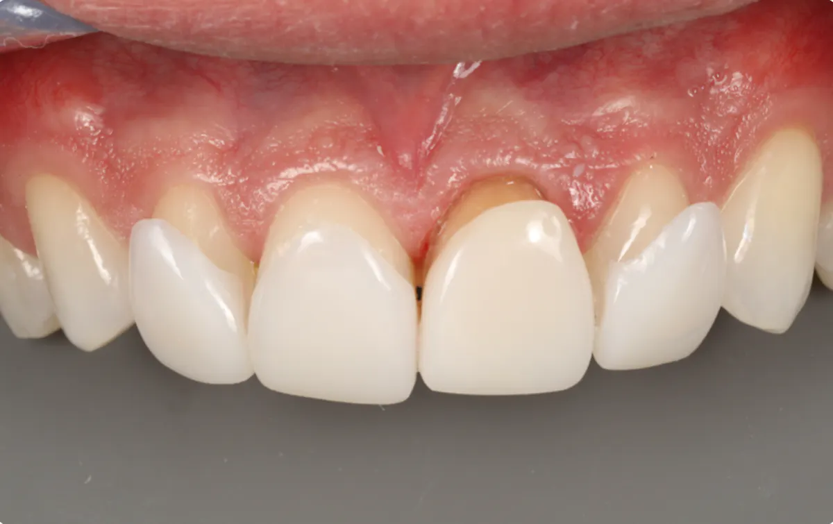 Direct-indirect composite veneers: Balancing esthetics and minimal ...