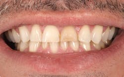 Figure 1. Pre-op photo: frontal pre-op view in maximum intercuspation. Note the wear of the maxillary central incisors, the irregular shape and length of the lateral incisors, and the discolored tooth structure on tooth no. 9. Figure 1. Pre-op photo: frontal pre-op view in maximum intercuspation. Note the wear of the maxillary central incisors, the irregular shape and length of the lateral incisors, and the discolored tooth structure on tooth no. 9.