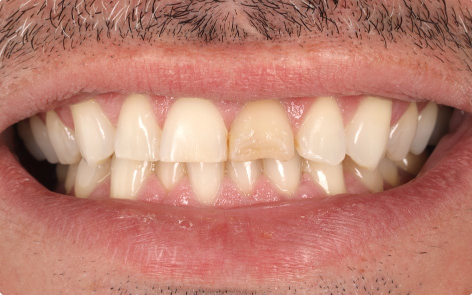 Figure 1. Pre-op photo: frontal pre-op view in maximum intercuspation. Note the wear of the maxillary central incisors, the irregular shape and length of the lateral incisors, and the discolored tooth structure on tooth no. 9.