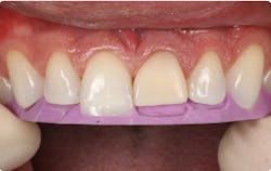 Figure 3: A silicone matrix fabricated from the diagnostic wax-up is used to aid the clinician in creating ideal lingual and incisal contours. The matrix is trimmed to the facioincisal edge, which guides the clinician in creating the optimal thickness of the incisal edge. Figure 3: A silicone matrix fabricated from the diagnostic wax-up is used to aid the clinician in creating ideal lingual and incisal contours. The matrix is trimmed to the facioincisal edge, which guides the clinician in creating the optimal thickness of the incisal edge.