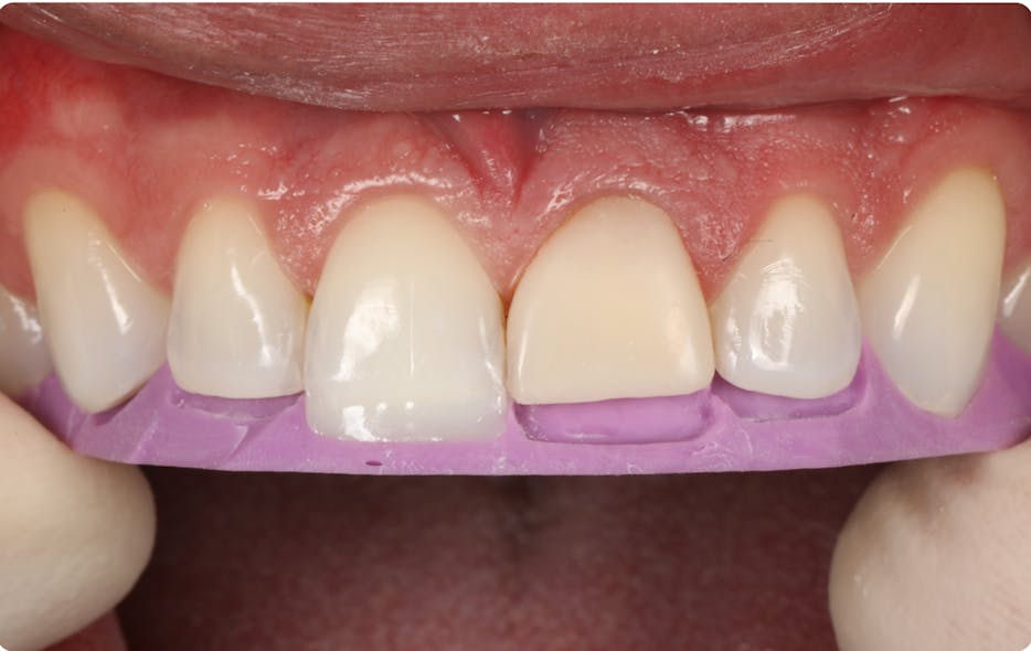 Figure 3: A silicone matrix fabricated from the diagnostic wax-up is used to aid the clinician in creating ideal lingual and incisal contours. The matrix is trimmed to the facioincisal edge, which guides the clinician in creating the optimal thickness of the incisal edge.