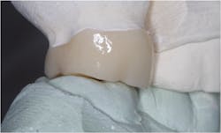 Figure 1: Note the significant lack of occlusal contact on this zirconia crown example as sent from a large dental laboratory.