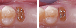 Figure 1: Many broken-down teeth can be restored and saved. In numerous ways, restored teeth are far better than implants because they move with occlusal forces; implants do not. Note the pure titanium pins (Filpin) placed about 15 degrees off from the long axis of the tooth and bent toward the center of the tooth. A buildup and a crown would save this tooth.