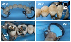 Figure 10: Typical rubber dam isolations depicting clamps W00, 0, W3, and W4 Figure 10: Typical rubber dam isolations depicting clamps W00, 0, W3, and W4
