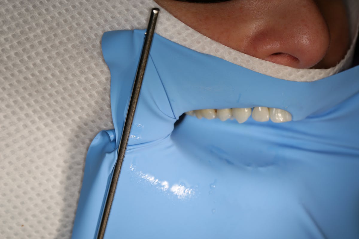 Rubber dam A key to better esthetic dentistry Dental Economics