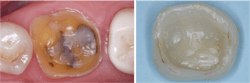 Figure 2: This crown came off in service and is from one of CR&rsquo;s in vivo zirconia studies. It was placed only a short time before the photo was taken. Note the thickness of the resin cement as observed in the void area on the occlusal intaglio surface of the crown and the staining on the margins that occurred after a very short time.