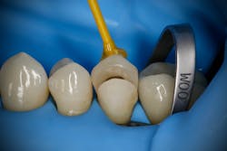 Figure 2: W00 providing additional gingival retraction in preparation of ceramic onlay cementation Figure 2: W00 providing additional gingival retraction in preparation of ceramic onlay cementation