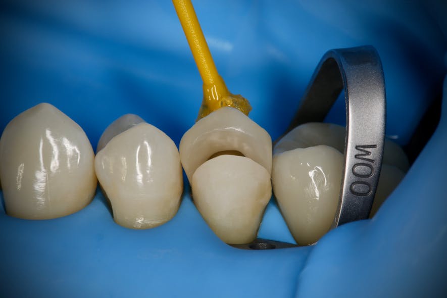 Figure 2: W00 providing additional gingival retraction in preparation of ceramic onlay cementation