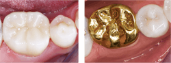 Figure 2: Laboratories report that zirconia crowns are by far the most requested crowns (personal communication, Darryl Withrow, Glidewell Laboratories). Are they better than cast-gold alloy? Only from an esthetic standpoint, but patients want white, and zirconia crowns are much easier and less expensive to make.