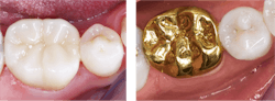 Figure 2: Laboratories report that zirconia crowns are by far the most requested crowns (personal communication, Darryl Withrow, Glidewell Laboratories). Are they better than cast-gold alloy? Only from an esthetic standpoint, but patients want white, and zirconia crowns are much easier and less expensive to make. Figure 2: Laboratories report that zirconia crowns are by far the most requested crowns (personal communication, Darryl Withrow, Glidewell Laboratories). Are they better than cast-gold alloy? Only from an esthetic standpoint, but patients want white, and zirconia crowns are much easier and less expensive to make.