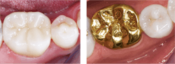 Figure 2: Laboratories report that zirconia crowns are by far the most requested crowns (personal communication, Darryl Withrow, Glidewell Laboratories). Are they better than cast-gold alloy? Only from an esthetic standpoint, but patients want white, and zirconia crowns are much easier and less expensive to make. Figure 2: Laboratories report that zirconia crowns are by far the most requested crowns (personal communication, Darryl Withrow, Glidewell Laboratories). Are they better than cast-gold alloy? Only from an esthetic standpoint, but patients want white, and zirconia crowns are much easier and less expensive to make.